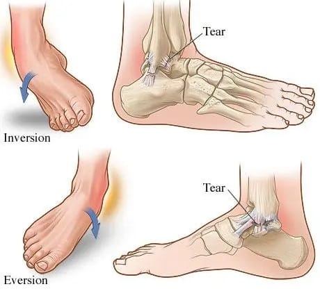 Muscle strain & sprain physiotherapy treatment in Behala, New Alipore & Tollygunge. Fast pain relief and recovery at HAPPY HEALTH PHYSIOCARE.