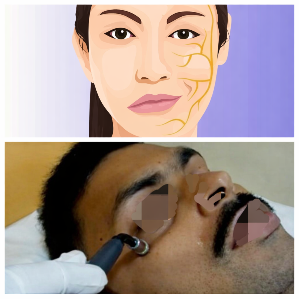 BELL'S PALSY / FACIAL PALSY PHYSIOTHERAPY TREATMENT